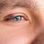 Eye Twitching – Reasons, Causes & Treatment