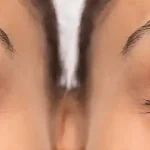 Right Time for Cataract Surgery