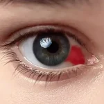 An eye with a subconjunctival haemorrhage, showing a red blood spot on the white part of the eye due to a broken blood vessel.