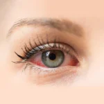 Infographic detailing conjunctivitis causes, symptoms, and treatments