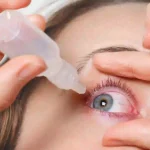Dry Eye Syndrome