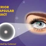 Posterior Subcapsular Cataract (PSC)