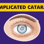 Complicated-Cataract