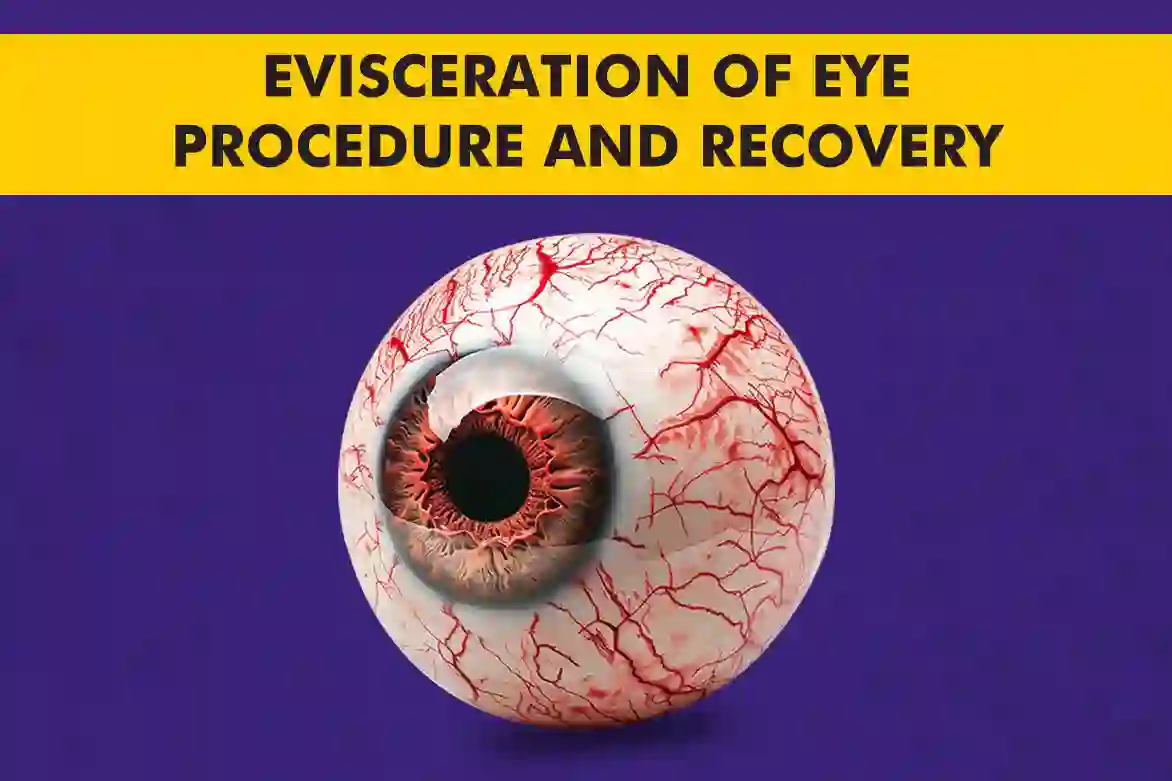 Evisceration procedure and recovery guide