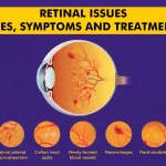 Retinal Diseases