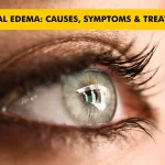 Corneal Edema: Causes, Symptoms, and Treatments for a Swollen Cornea