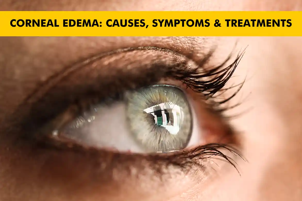 Corneal Edema: Causes, Symptoms, and Treatments for a Swollen Cornea