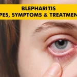 Blepharitis