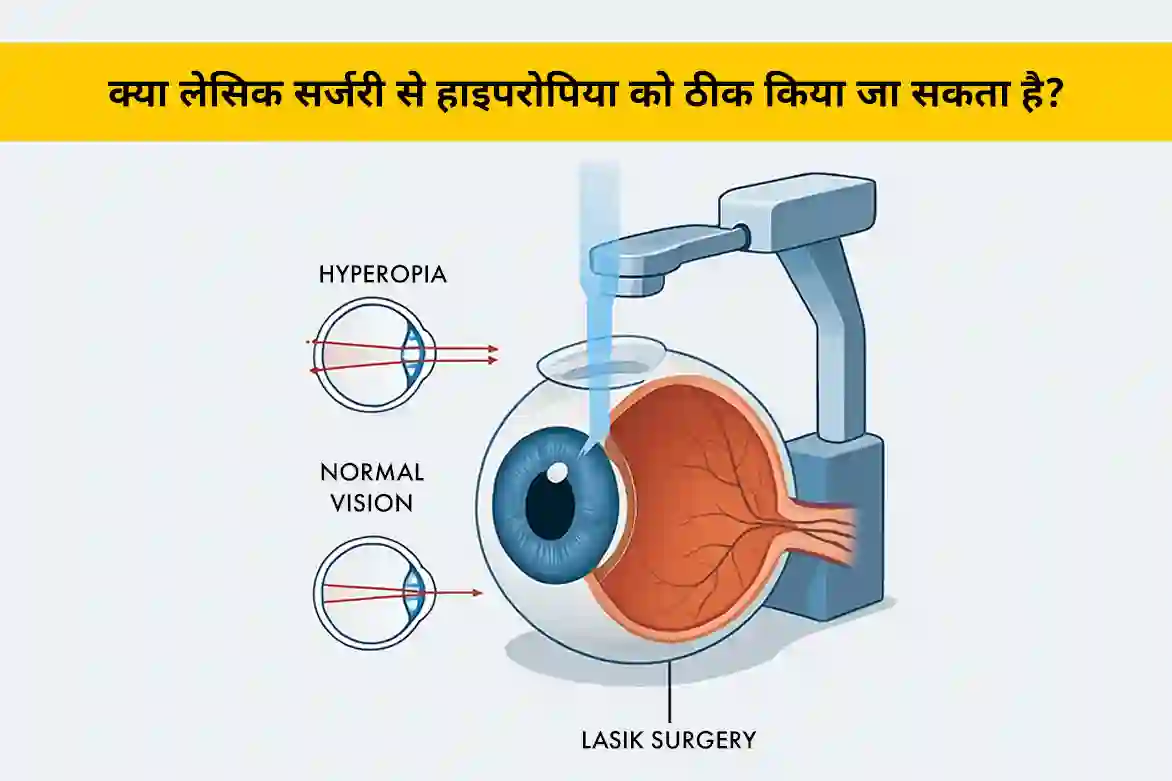 क्या लेसिक सर्जरी से हाइपरोपिया को ठीक किया जा सकता है