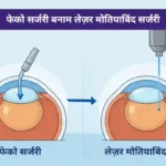 फेको सर्जरी बनाम लेज़र मोतियाबिंद सर्जरी कौन बेहतर है