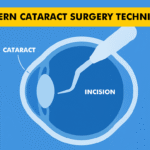 Modern Cataract Surgery